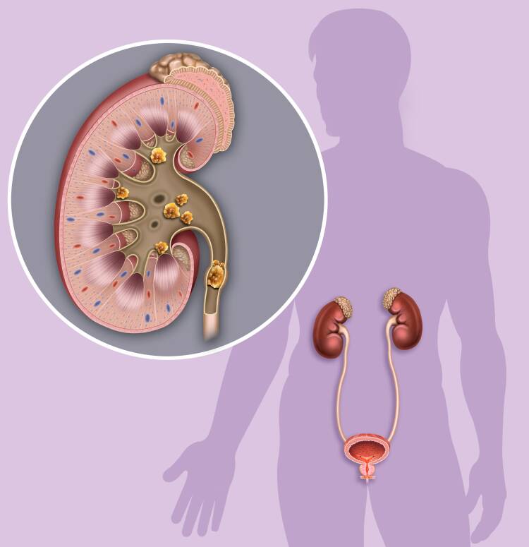 kidney stones, urolithiasis, lithiasis, dysuria, पथरी, अश्मरी, मूत्रकृच्छ, પથરી, અશ્મરી, મૂત્રકૃચ્છ