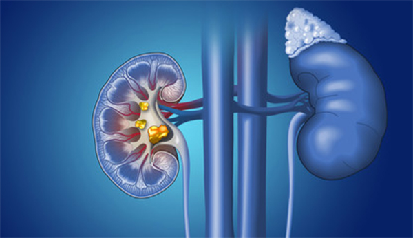 kidney stones, urolithiasis, lithiasis, dysuria, पथरी, अश्मरी, मूत्रकृच्छ, પથરી, અશ્મરી, મૂત્રકૃચ્છ