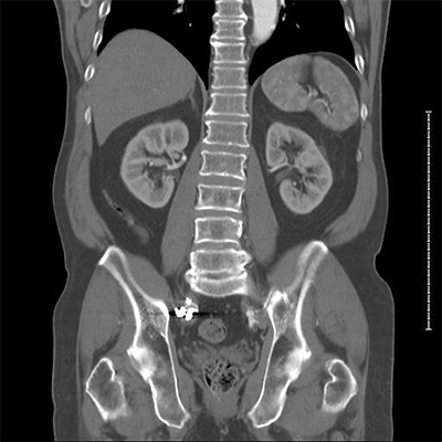 kidney stones, urolithiasis, lithiasis, dysuria, पथरी, अश्मरी, मूत्रकृच्छ, પથરી, અશ્મરી, મૂત્રકૃચ્છ