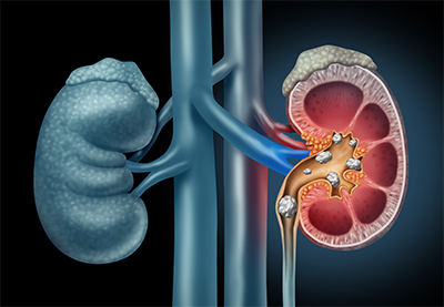 kidney stones, urolithiasis, lithiasis, dysuria, पथरी, अश्मरी, मूत्रकृच्छ, પથરી, અશ્મરી, મૂત્રકૃચ્છ